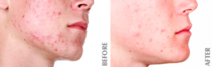 LED light therapy acne before and after treatment