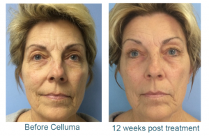 LED light therapy wrinkles before and after woman