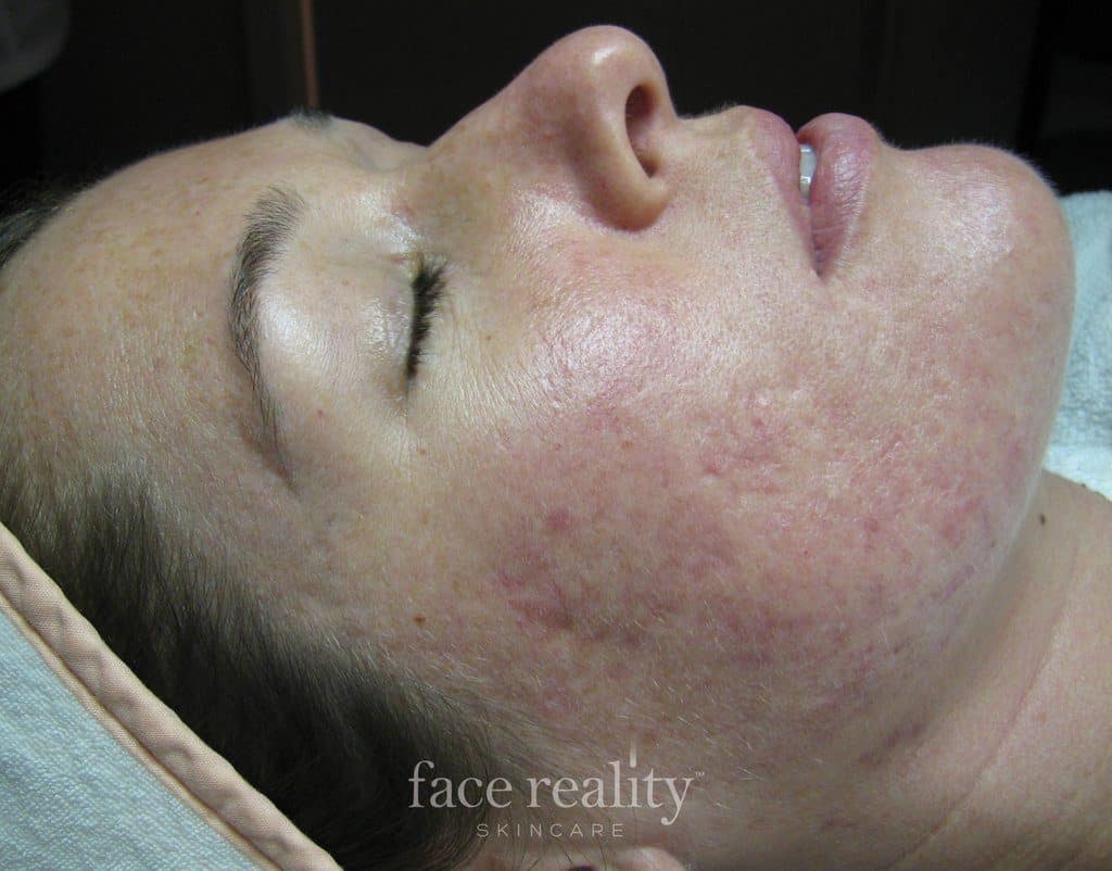 Face Reality Acne Clearing Treatment