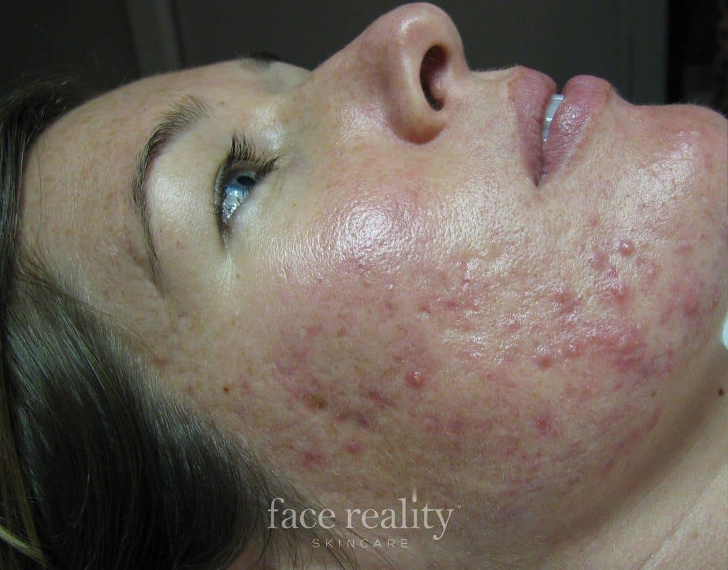 Face Reality Acne Clearing Treatment