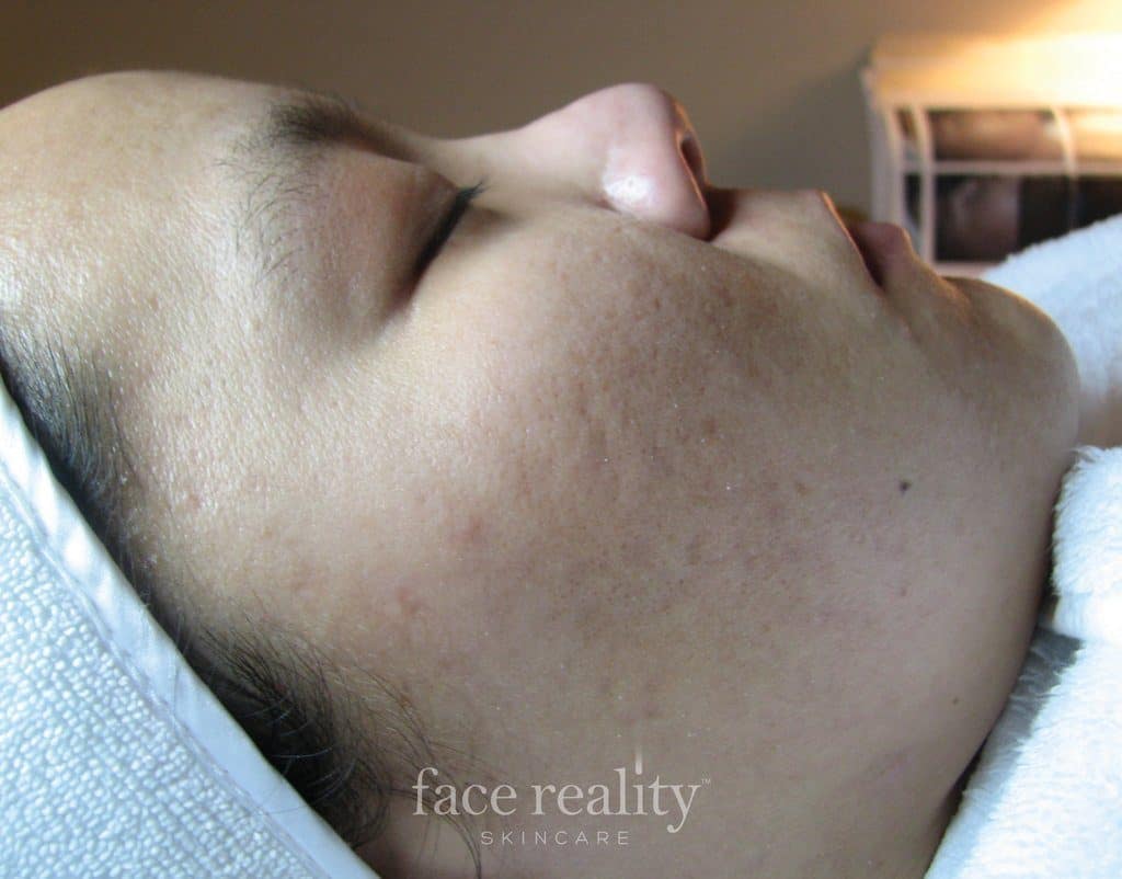 Face Reality Acne Clearing Treatment