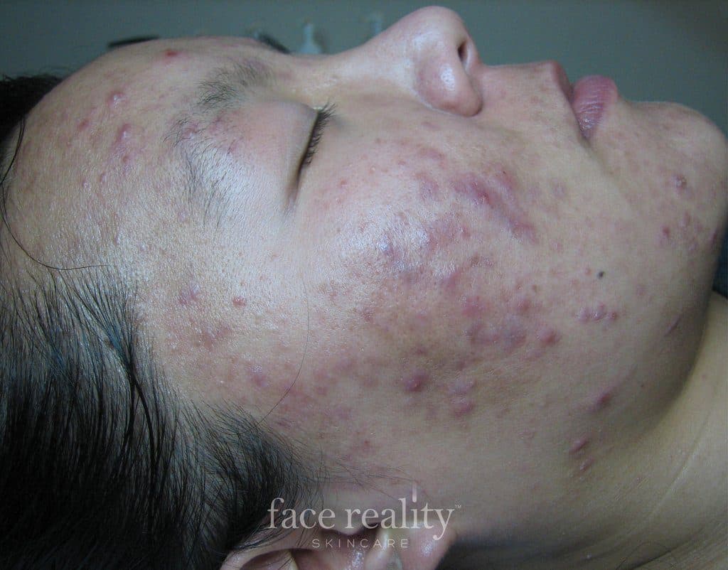 Face Reality Acne Clearing Treatment