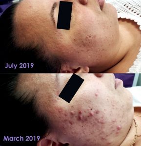 Before and after face reality acne program