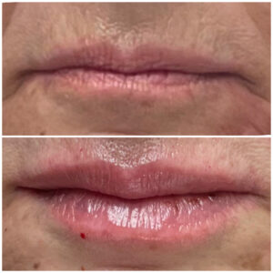 botox lips before and afer