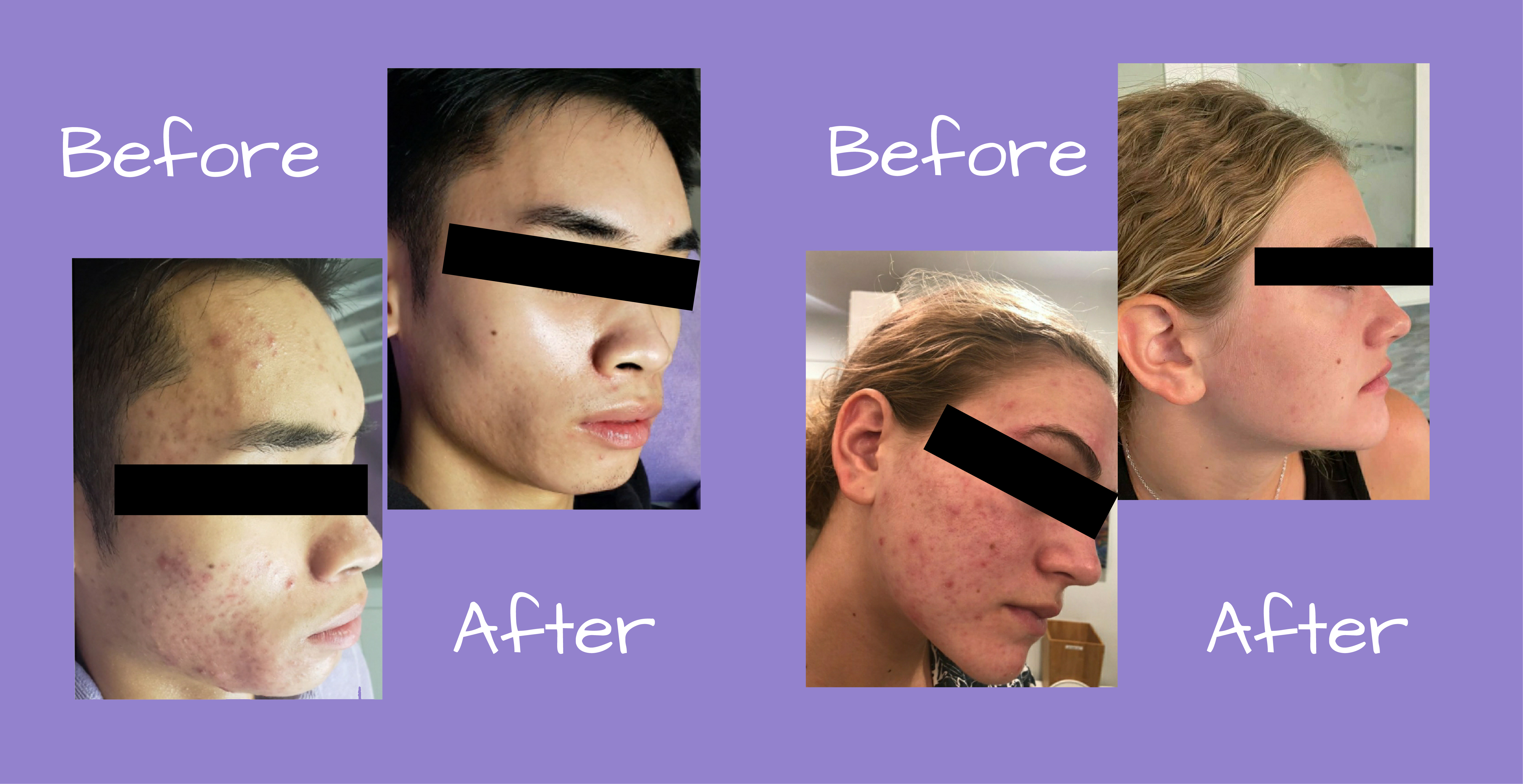 acne program before and after