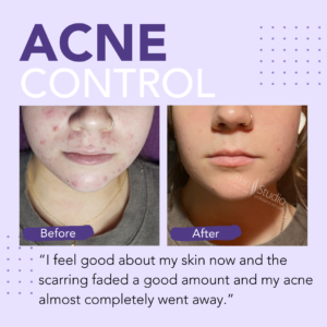 acne control